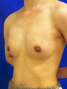 ⑤術後1ヶ月　左斜位